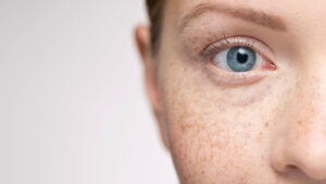 Exploring Professional Treatments for Hyperpigmentation: A Comprehensive Overview