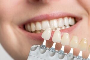 Dental Veneers Vs. Other Cosmetic Dentistry Options in Tukwila
